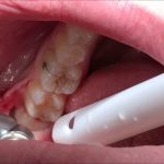 What to Expect and 7 Important Care Tips After a Wisdom Tooth Extraction