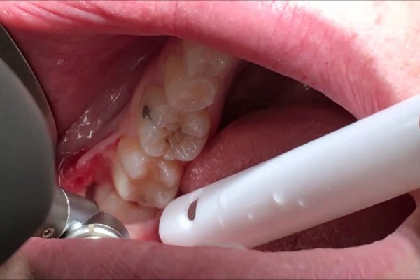 Care Tips After a Wisdom Tooth Extraction